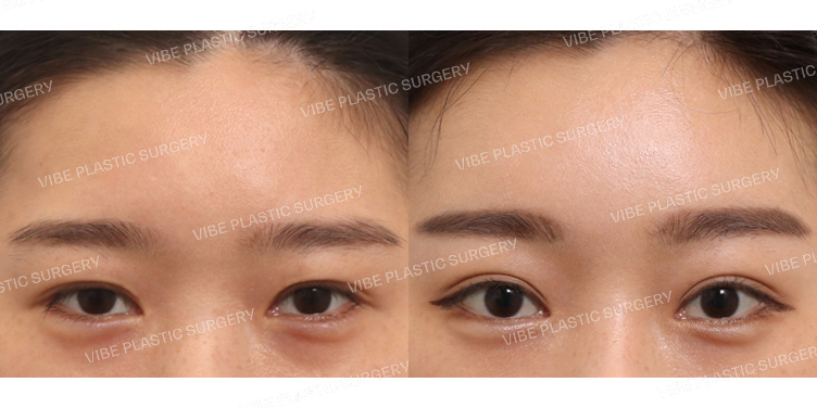 #내시경이마거상 #절개눈매교정(재수술)