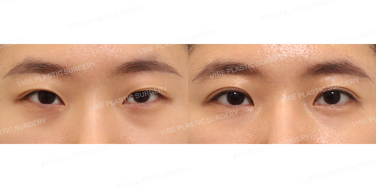 #절개눈매교정(재수술)