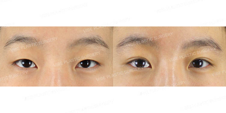 #비절개눈매교정