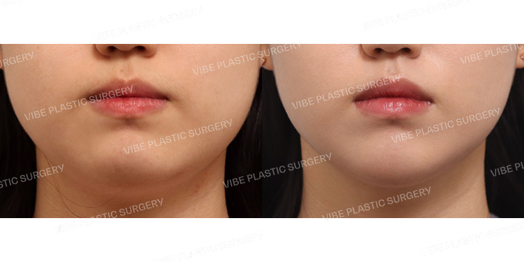 #초음파지방흡입(이중턱,턱라인)