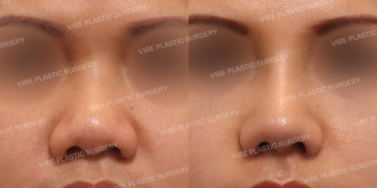 #복코 #낮은코 #콧볼축소