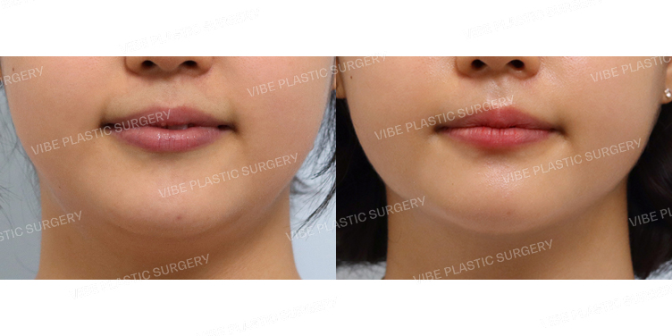 #초음파지방흡입(이중턱,턱라인)