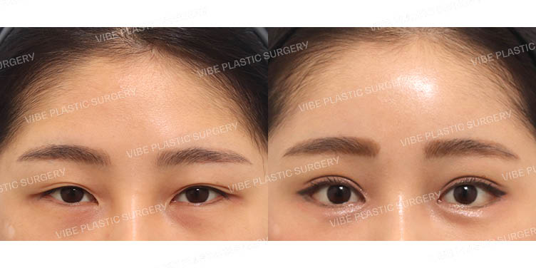 #절개쌍꺼풀(재수술) #뒤트임 #밑트임 #내시경이마거상