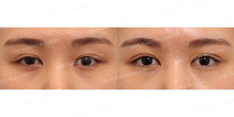 #비절개눈매교정(재수술) #앞트임 #뒤트임 #밑트임