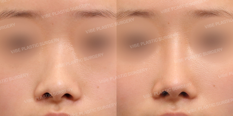 #이물질제거 #낮은코