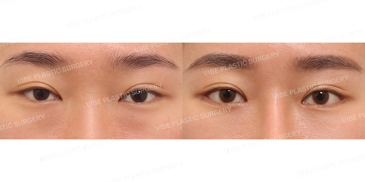 #뒤트임 #밑트임 #눈밑지방재배치