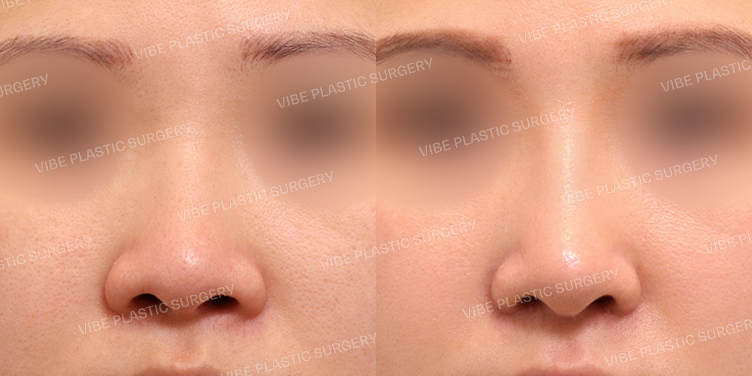 #복코 #콧볼축소