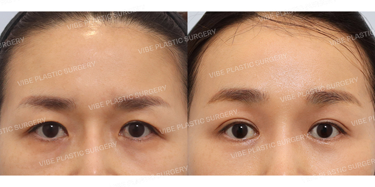 #내시경이마거상 #자연유착 #하안검