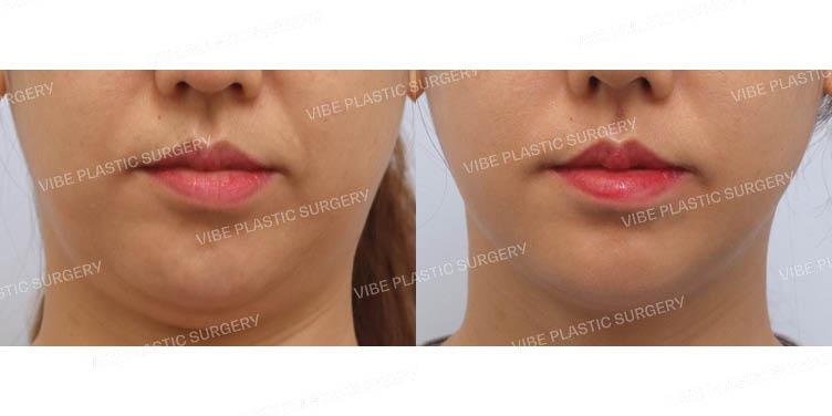 #이중턱지방흡입