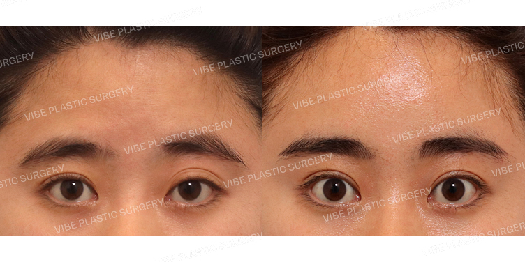 #내시경이마거상 #절개눈매교정(재수술)