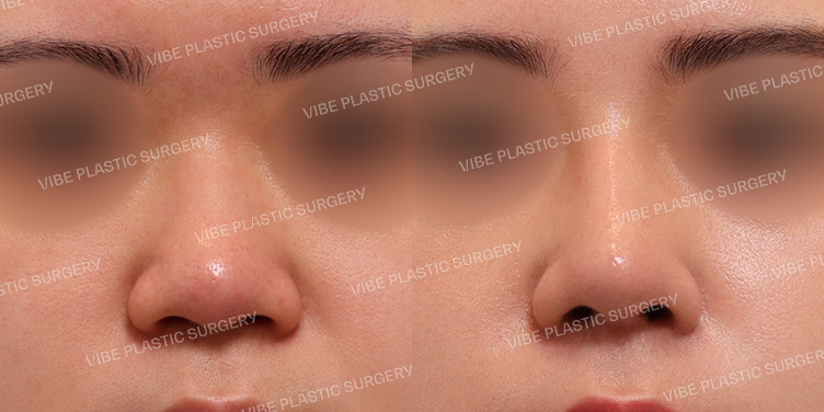 #매부리코 #복코 #비순각교정