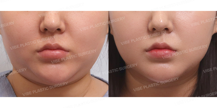 #초음파지방흡입(이중턱,턱라인,앞볼) #침샘보톡스 #이중턱실리프팅