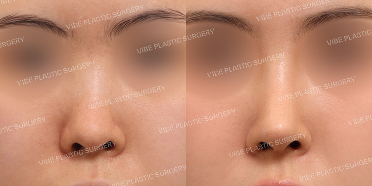 #짧은코 #낮은코