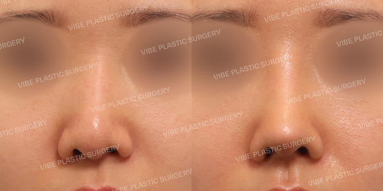 #휜코(재수술) #코끝