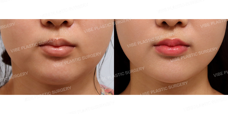 #초음파지방흡입(이중턱,턱라인)