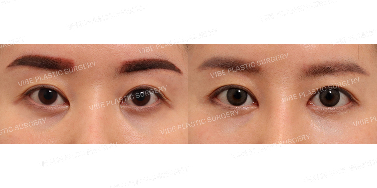 #앞트임 #뒤트임 #밑트임