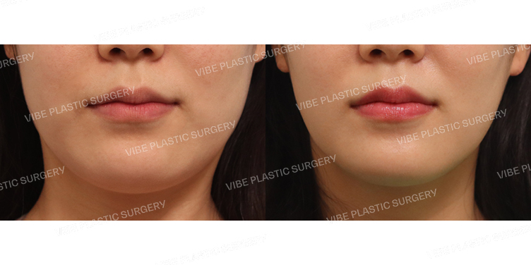 #초음파지방흡입(이중턱,턱라인)