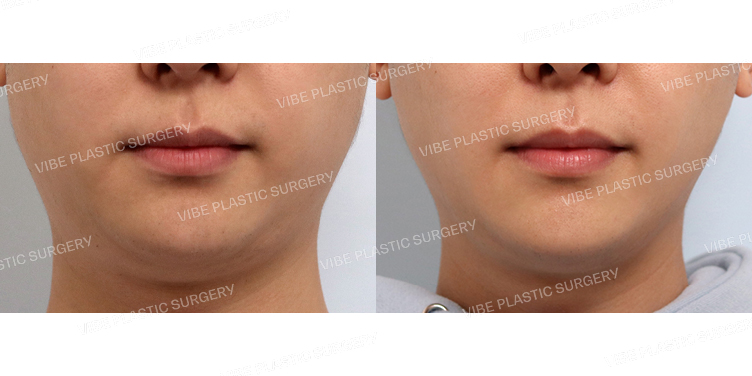 #초음파지방흡입(이중턱,턱라인)