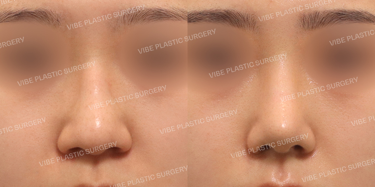 #무보형물 #매부리코 #복코 #긴코