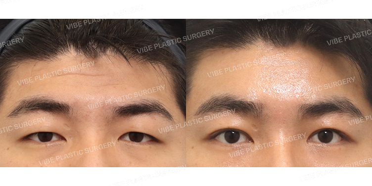 #절개눈매교정 #내시경이마거상