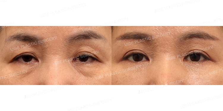 #눈썹밑거상 #하안검