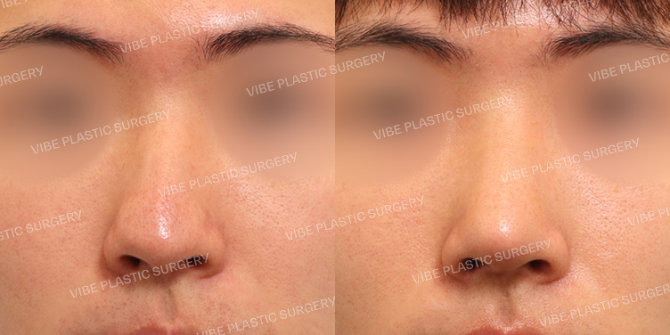 #무보형물 #매부리코 #복코 #코끝