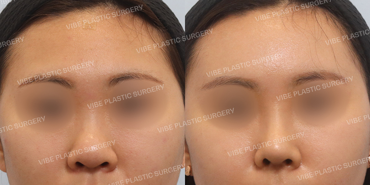 #이마지방이식 #복코