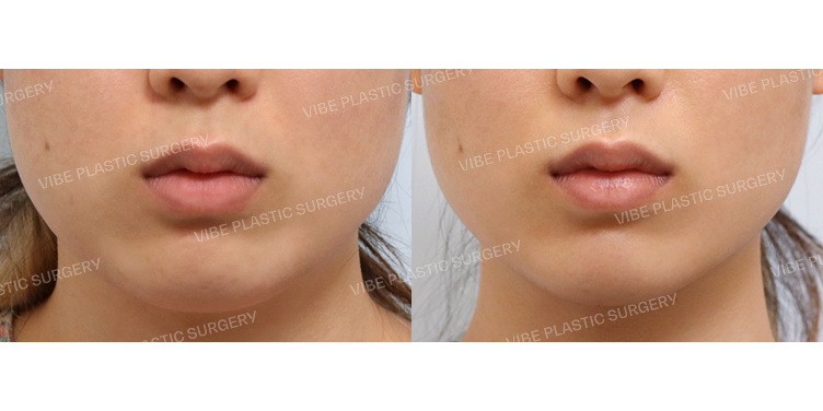 #초음파지방흡입(이중턱,턱라인)