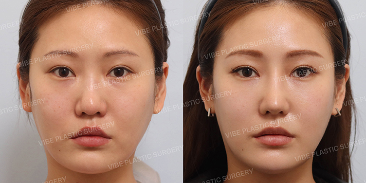 #콧대 #복코 #비순각성형 #비중격연장이식