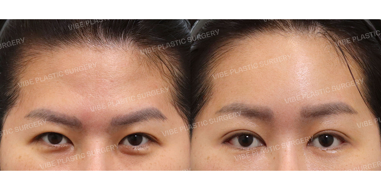 #내시경이마거상 #절개눈매교정(재수술) #앞트임 #뒤밑트임