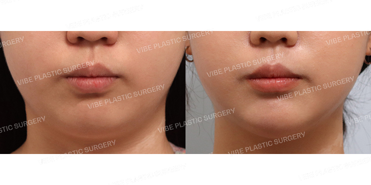 #초음파지방흡입(턱라인) #턱끝필러