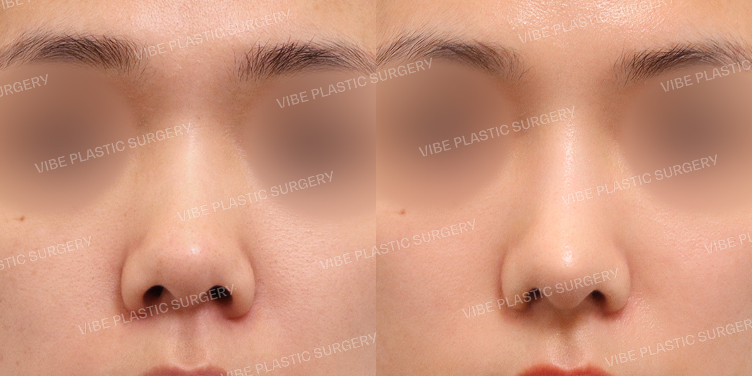 #코재수술 #매부리코 #복코 #짧은코