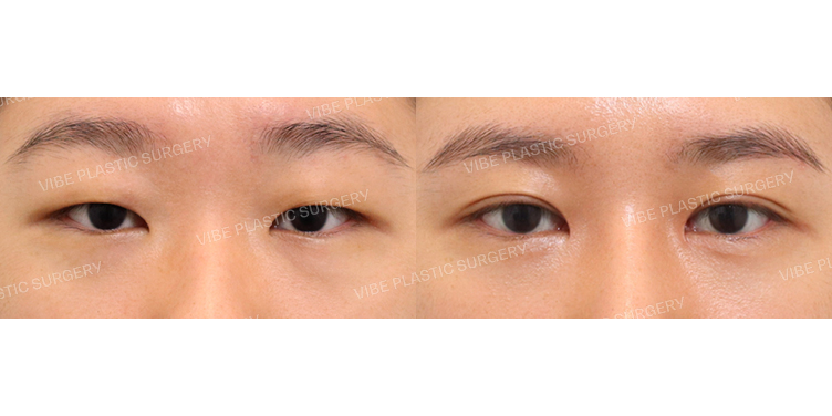 #부분절개쌍꺼풀 #앞트임