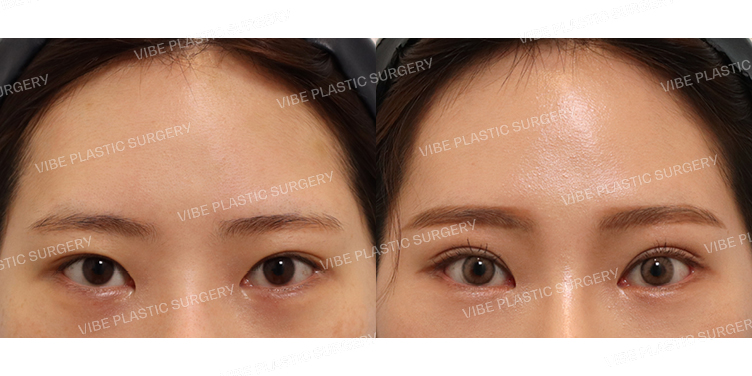 #내시경이마거상 #눈재수술 #절개쌍꺼풀