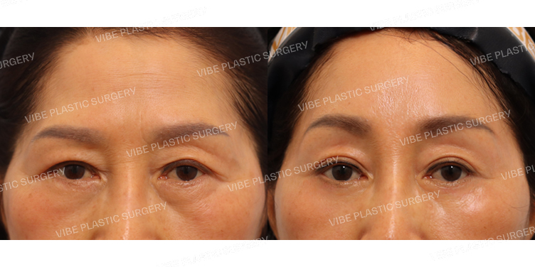 #내시경이마거상 #하안검(재수술)