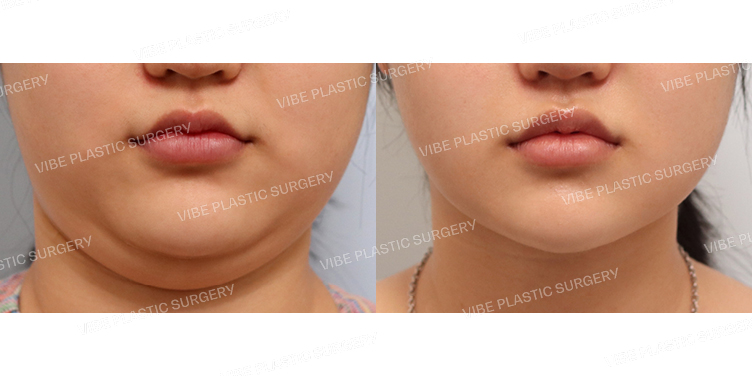 #초음파지방흡입(이중턱,턱라인)