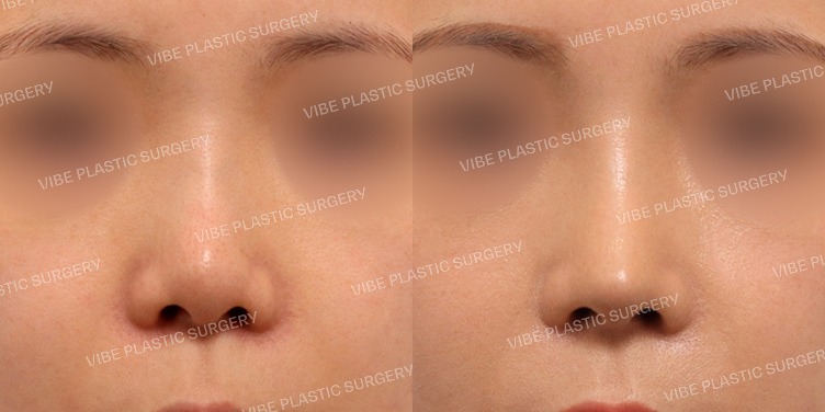 #코재수술 #짧은코