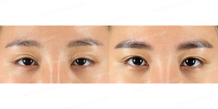 #비절개눈매교정