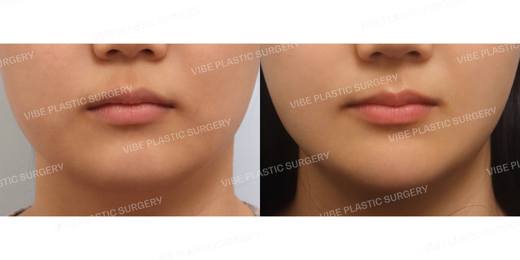 #턱끝지방이식 #초음파지방흡입(이중턱,턱라인)