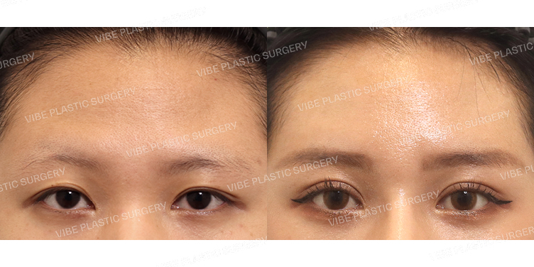 #절개쌍꺼풀(재수술) #내시경이마거상