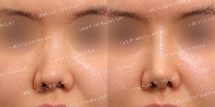 #휜코(재수술) #기능코