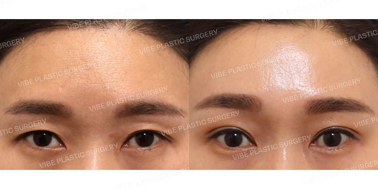 #내시경이마거상 #자연유착