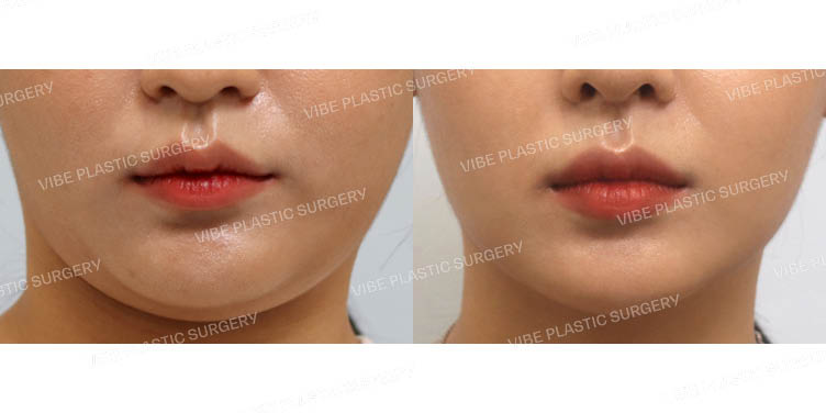 #이중턱지방흡입 #심부볼지방제거