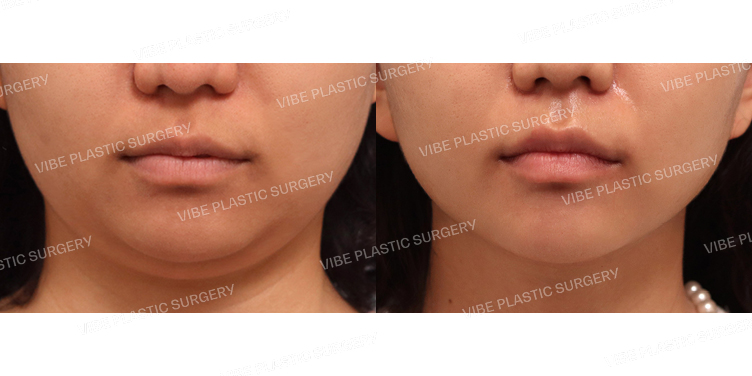 #초음파지방흡입(이중턱,턱라인)