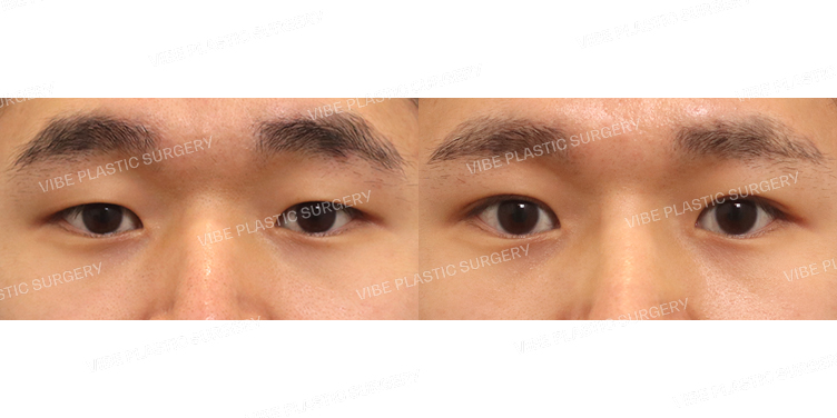 #부분절개눈매교정