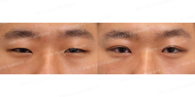 #비절개눈매교정 #앞트임