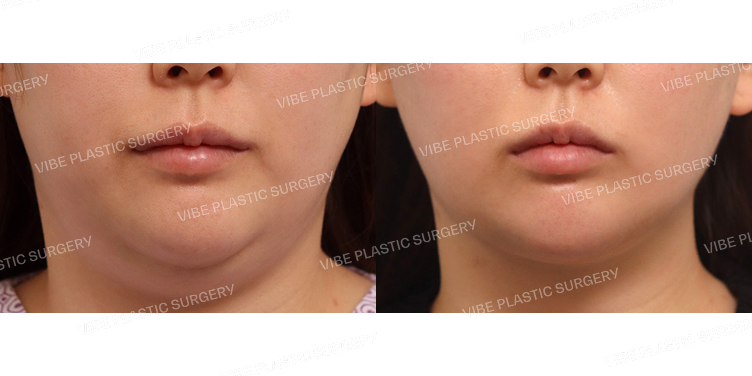 #초음파지방흡입(이중턱,턱라인)