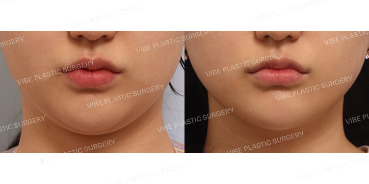 #리포사운드지방흡입(이중턱)