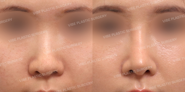 #매부리코 #휜코 #기능코