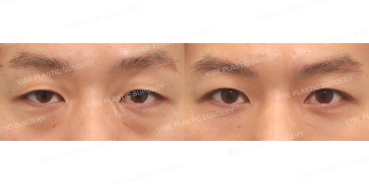 #무쌍눈매교정 #눈밑지방재배치